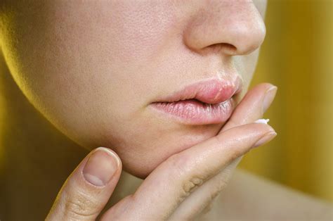 Symptoms Of Yeast On Lips