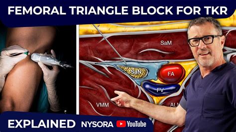 Femoral Triangle Block For Tkr Youtube