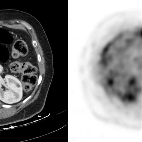 Pulmonary nodule with lobulated margins. Figure 6. Benign granuloma ...