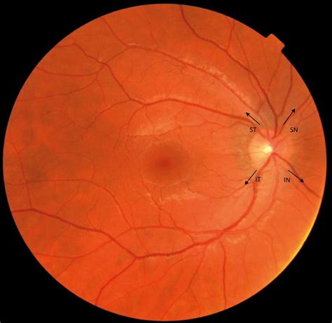 Ophthalmic Artery And Optic Nerve