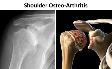 Shoulder Joint Arthritis