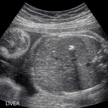 calcification on baby liver ultrasound ...