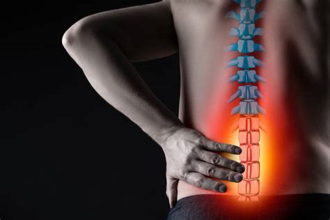 Aspectos Clave De La Artrosis De Columna Lumbar Cl Nica Indolore