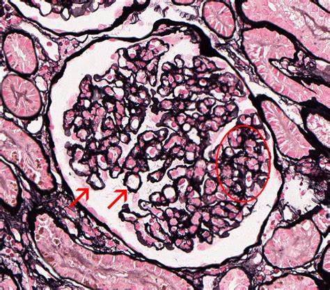 Membranoproliferative Glomerulonephritis