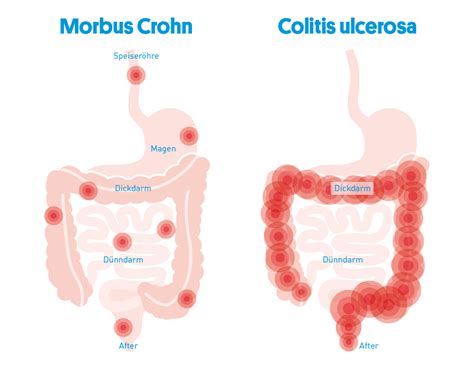 Chronisch Entz Ndliche Darmerkrankungen Ced Leben Mit Ced