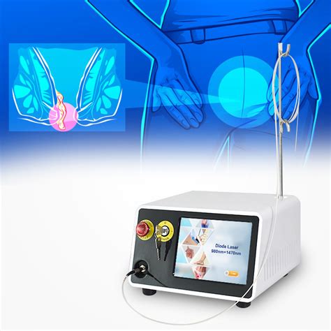 Anal Fistula And Hemorrhoids Laser Nm Hemorrhoids Treatment Surgery Hemorrhoidectomy Device