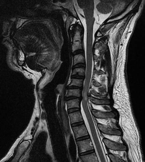 Cervical Myelopathy Wikimsk