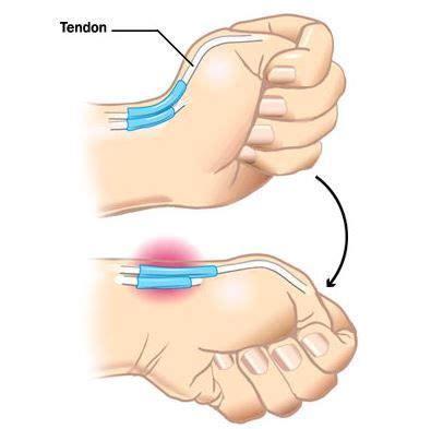 C Mo Saber Si Tengo Una Tendinitis O Una Tendinopat A Dupuytren S