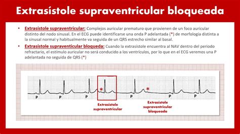 CardioTruco extrasístoles supraventriculares Cardioprimaria Ferrol