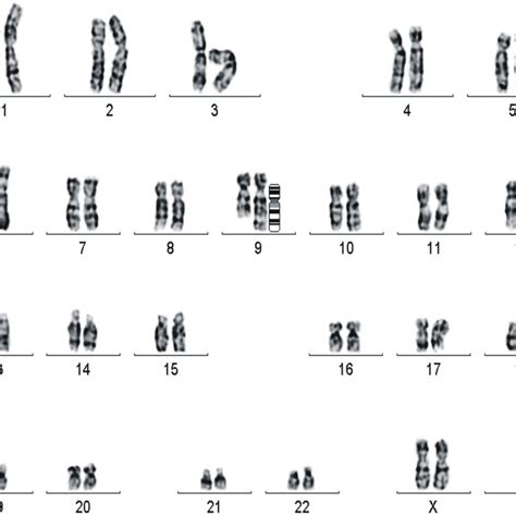 (PDF) Structural chromosomal anomalies detected by prenatal genetic diagnosis: Our experience