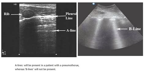 Ultrasonographic Features Of Pneumothorax Deranged Physiology