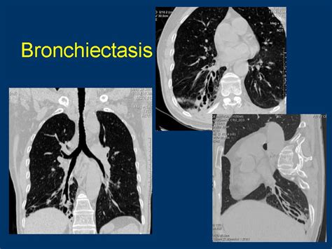 Mild Cylindrical Bronchiectasis Comprehensive Guide To Treatment