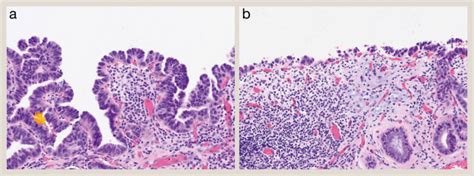 Preinvasive Neoplasia Of The Gallbladder Flat And Tumoral Dysplasia