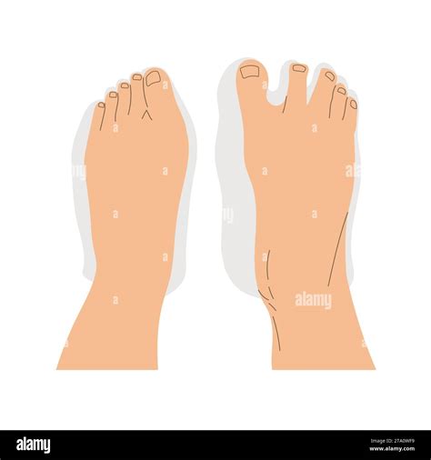 Top View Comparison Of Healthy And Deformed Feet After Wearing Regular