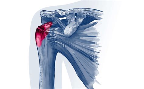 Rupture de la coiffe des rotateurs ISCO Institut Spécialisé de