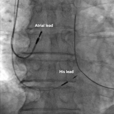 Intracardiac Signals Of His Potential Obtained From The Kodex Epd Download Scientific Diagram