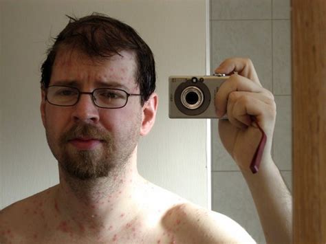 CHICKEN POX SYMPTOMS IN ADULTS. CHICKEN POX SYMPTOMS - CHICKEN POX