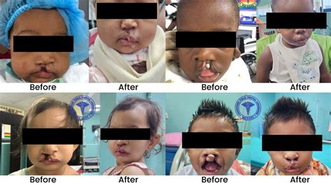 Nine Successful Cleft Surgeries Performed Independently At GPHC News