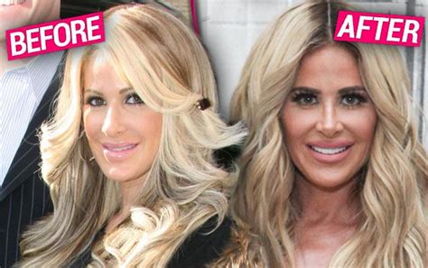 Kim Zolciak Biermann Plastic Surgery Claims Exposed By Top Docs