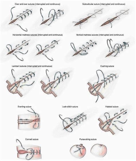 Nurses Notes Understanding Different Types Of Sutures The Nurse Wanderer Sutures Nurse