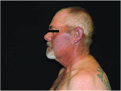Left Profile Of The Patient Showing Kratom Hyperpigmentation
