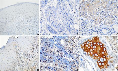 Expression Of Par And Phlda In Oral Squamous Cell Carcinoma And