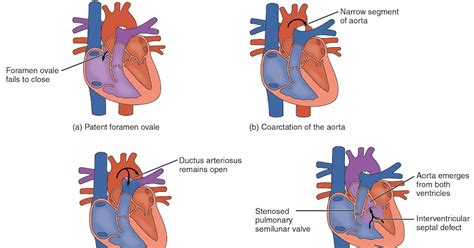 The Influence Of Sex Age And Race On Coronary Artery Disease A