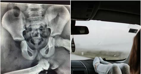 The Shocking X Ray That Shows Why You Should Not Put Your Feet On The