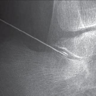 Radiograph Shows Imaging Guided Injection Into Subtalar Joint With