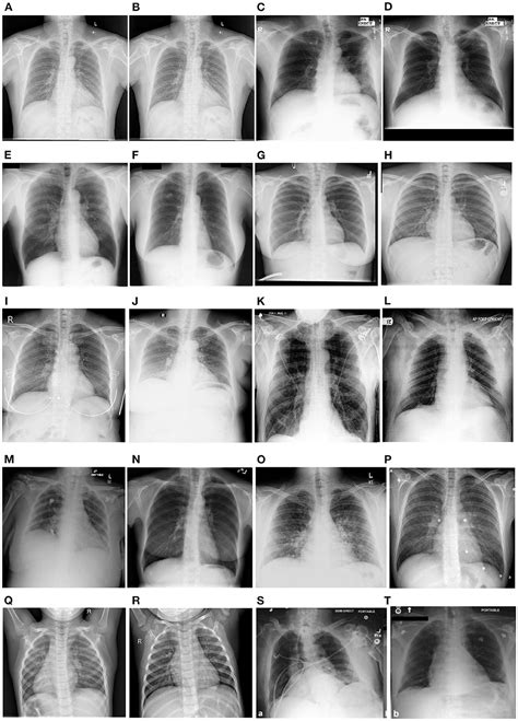 Frontiers Ai Based Radiodiagnosis Using Chest X Rays A Review