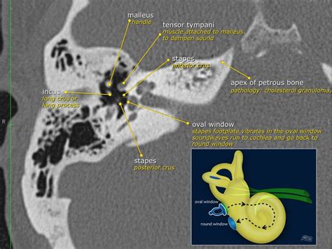 The Radiology Assistant Temporal Bone Anatomy 20 Radiology