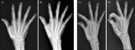 Hand X-rays A AP and C oblique preoperative X-rays; B AP and D oblique ...