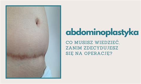 Abdominoplastyka co warto wiedzieć przed operacją