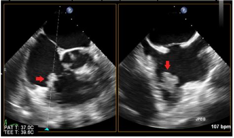 Tee 2 D Image Showing A Large Mobile Vegetation In The Tricuspid Valve Download Scientific