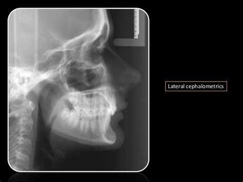 Class Ii Malocclusion