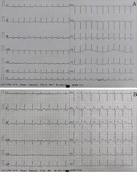 A Electrocardiograph Showed Sinus Tachycardia B Electrocardiograph