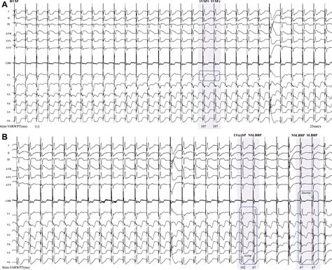 A Continuous Pacing And Recording Technique For Differentiating Left