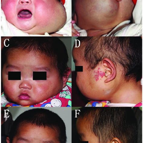 Infantile Hemangioma On The Left Parotid Region A And B Before