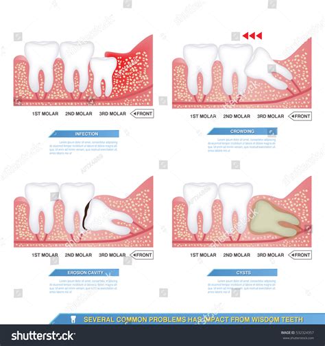 cyst tooth images browse  stock  vectors