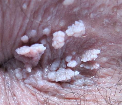 Anal Condyloma Colon Rectal Specialist Serving VA Colon Rectal Specialists LTD