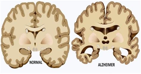 5 Hidden Causes of Alzheimer's Most People Don't Know! - David Avocado ...