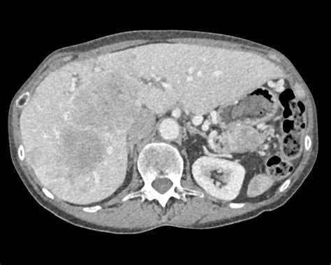 Metastatic Neuroendocrine Tumor Of The Tail Of The Pancreas With Liver