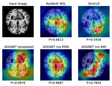 Sensors Free Full Text Computer Aided Diagnosis Of Alzheimers