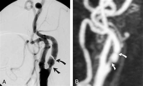 Underestimation Of Stenoses A DSA Image Of The Left Common Carotid