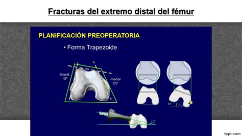 Fractura De Femur Distal Youtube