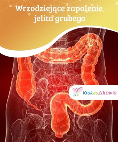 Wrzodziej Ce Zapalenie Jelita Grubego Wzjg Przyczyny Objawy I Hot Sex Picture