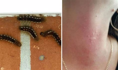 Rash Outbreak As Britain Invaded By Brown Tail Moth Larvae Nature News Uk