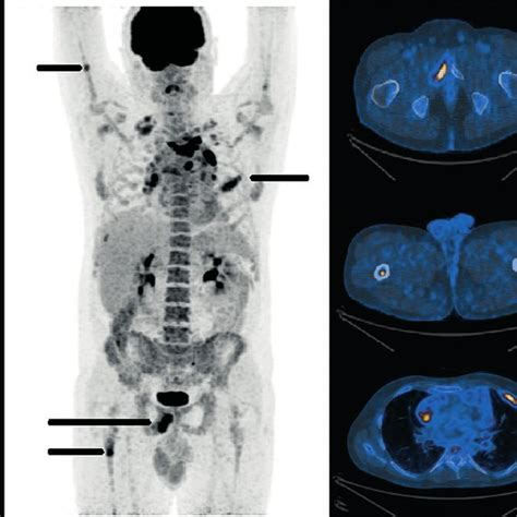 Pdf The Role Of Fdg Pet In Hodgkin Lymphoma