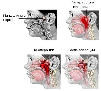 Аденотомия