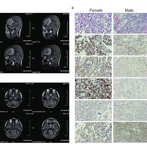 | Imaging and histology of the brain tumors. (A, B) CT scan images of ...